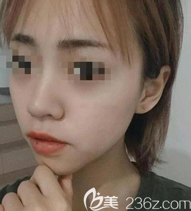 磨骨手術(shù)3個(gè)月恢復(fù)照片 磨骨手術(shù)3個(gè)月恢復(fù)照片