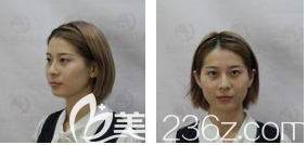 保定藍山醫(yī)療美容醫(yī)院于超術(shù)前照片1