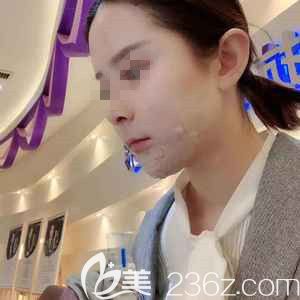 脂肪填充面部術(shù)后7天臉有點腫脹 脂肪填充面部術(shù)后7天臉有點腫脹