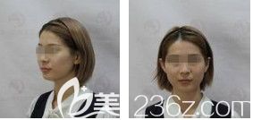 術(shù)前面部凹陷顯老 術(shù)前面部凹陷顯老