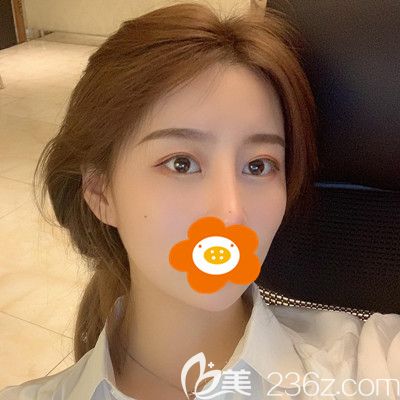 做了雙眼皮綜合手術(shù)半年時(shí)間寬度和弧度我都滿意，今天來說下感受！