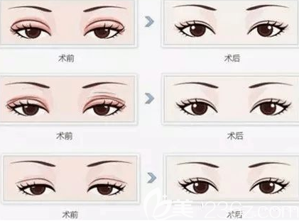 割雙眼皮選擇季節(jié)很重要