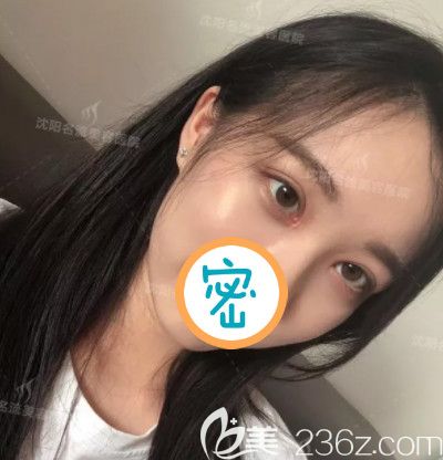 雙眼皮開(kāi)眼角術(shù)后恢復(fù)好的效果照 雙眼皮開(kāi)眼角術(shù)后恢復(fù)好的效果照