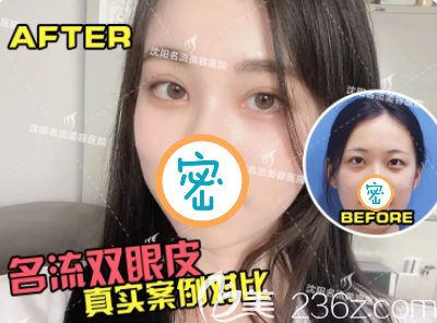 沈陽(yáng)名流雙眼皮開(kāi)眼角真人術(shù)前術(shù)后對(duì)比效果照片 沈陽(yáng)名流雙眼皮開(kāi)眼角真人術(shù)前術(shù)后對(duì)比效果照片