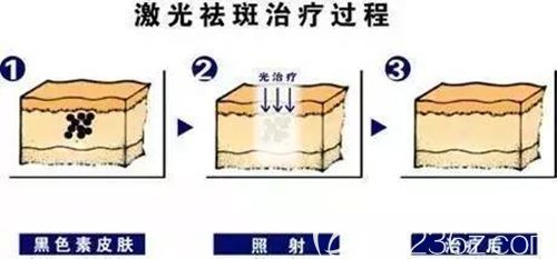 許醫(yī)生做激光祛疤的手術(shù)原理 許醫(yī)生做激光祛疤的手術(shù)原理