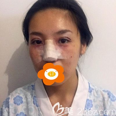 剛做完手術(shù)拍的照片