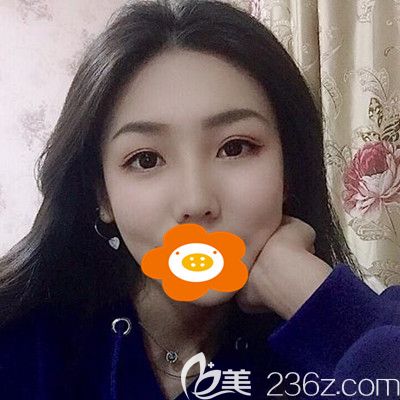本來還糾結(jié)雙眼皮和隆鼻先做哪個，誰知兩個一起做的效果超出了我的預期！