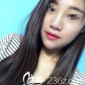 拯救大餅?zāi)槻灰幌胫雒娌课中g(shù)其實(shí)膨體墊下巴也有超棒的瘦臉效果