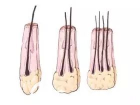 毛囊中的頭發(fā)數(shù)量在1-4根左右