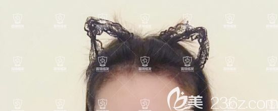 植發(fā)際線一個月了，長出了小絨毛