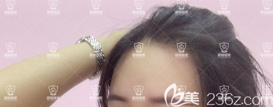 95后小姐姐來分享圓弧形發(fā)際線種植經(jīng)歷，為了變美！所以“植”得
