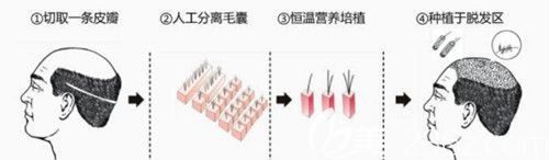 胡志浩醫(yī)生采用FUE植發(fā)技術(shù) 胡志浩醫(yī)生采用FUE植發(fā)技術(shù)