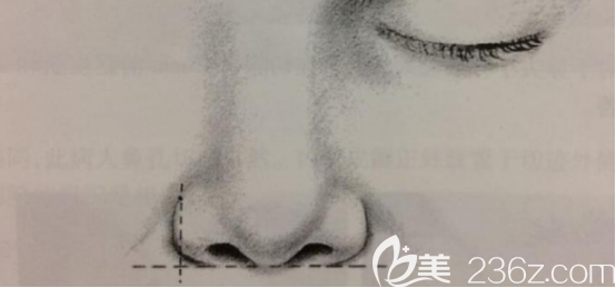 確認自己是否只需要做鼻翼縮小的方法