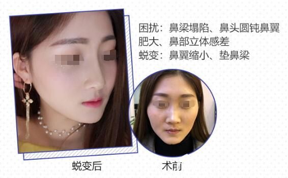 發(fā)小做隆鼻后前后對(duì)比效果 發(fā)小做隆鼻后前后對(duì)比效果