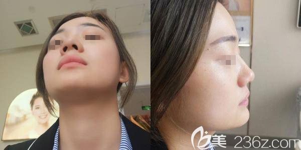 隆鼻術(shù)前朝天鼻子 隆鼻術(shù)前朝天鼻子