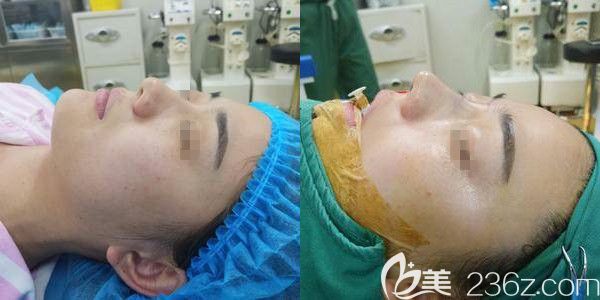 剛做完溫莎假體隆鼻+耳軟骨墊鼻尖術(shù)后效果 剛做完溫莎假體隆鼻+耳軟骨墊鼻尖術(shù)后效果