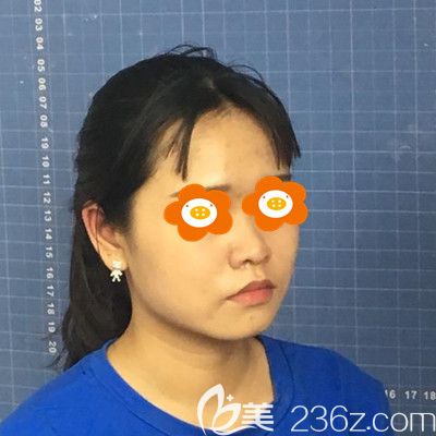 做埋線提升手術(shù)前的我 做埋線提升手術(shù)前的我