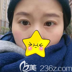 都以為我花了一萬多做眼綜合才改善了大小眼，其實只花了不到一半的價錢