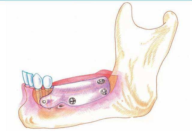 骨增量技術(shù)