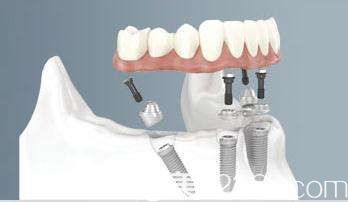 全口/半口種植牙