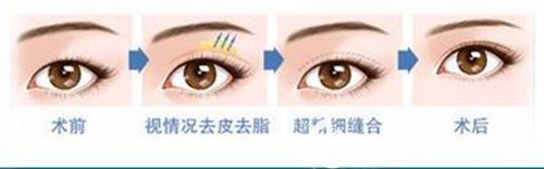 高主任做眼部整形的手術步驟示意圖