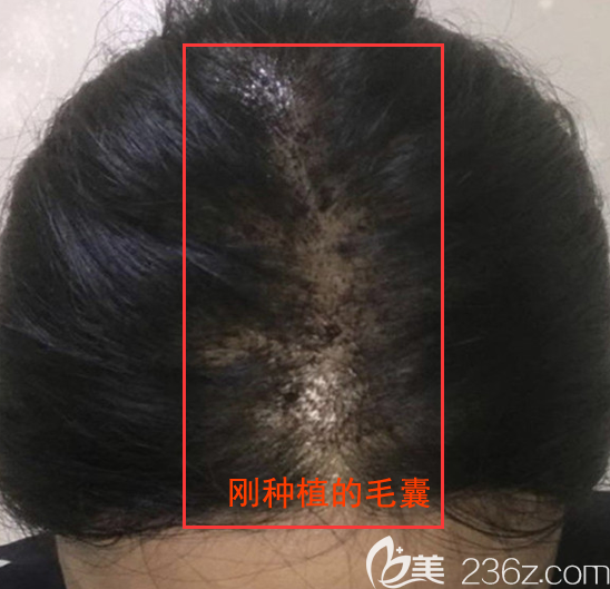 頭頂加密種植術(shù)后即刻照片