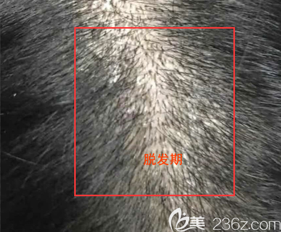 脫發(fā)期小毛茬明顯變少了，還多了頭皮屑