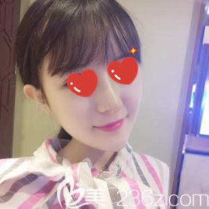 自體脂肪填充面部術(shù)后5天臉型改善明顯