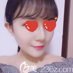 面部填充術(shù)后20天腫脹針眼消除