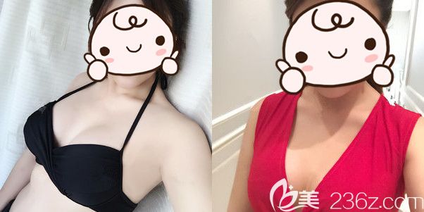 想要假體隆胸罩杯增大+脂肪填充的手感，復(fù)合隆胸滿足了我的貪心