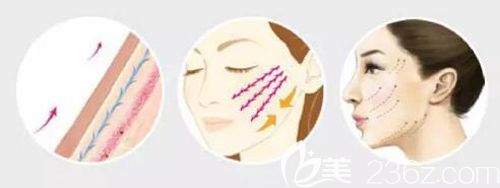 韓醫(yī)生做埋線提升除皺的原理圖 韓醫(yī)生做埋線提升除皺的原理圖