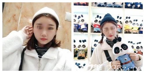 從術后效果來看鼻綜合手術確實是除了眼綜合之外讓人變化較大的整形項目了