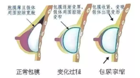 假體豐胸后出現(xiàn)包膜攣縮的變化過程