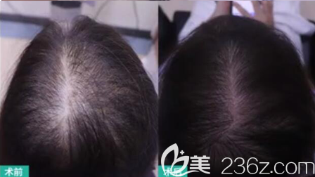 頭發(fā)細軟稀疏發(fā)縫變寬后，我是通過這種方式實現(xiàn)密發(fā)生發(fā)的效果的！