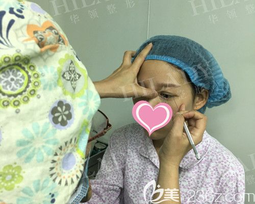 雙眼皮手術(shù)設(shè)計(jì)中