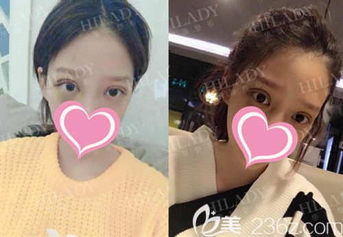 雙眼皮手術(shù)術(shù)后7天