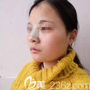 做完隆鼻手術(shù)3天的時候