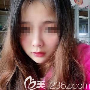 術(shù)后28天鼻子消腫比較明顯