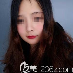  對于我這種鼻梁矮鼻頭不太大的人其實單純做硅膠隆鼻效果也挺不錯