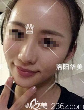 脂肪填充5天恢復(fù)效果