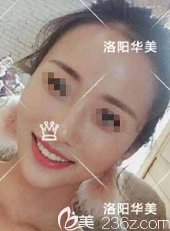 脂肪填充一個月恢復(fù)效果