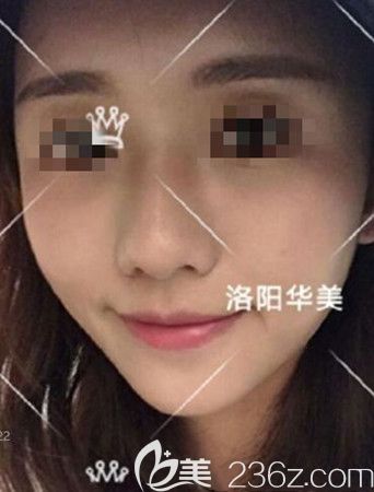 怕自體脂肪填充全臉很假的快速看這篇恢復(fù)很自然的圖片對(duì)比效果來避坑