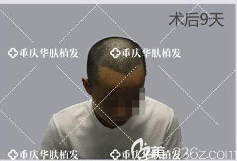 植發(fā)后第9天，頭上長出了發(fā)茬