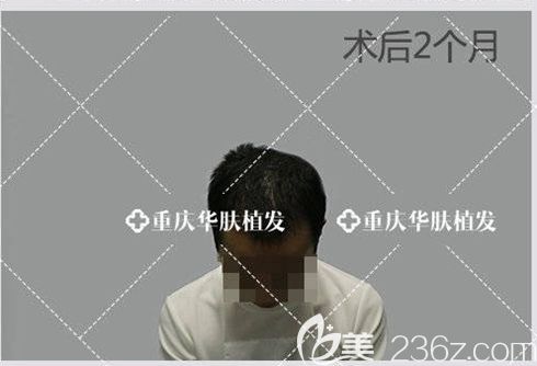 植發(fā)有兩個月遇上了脫落期