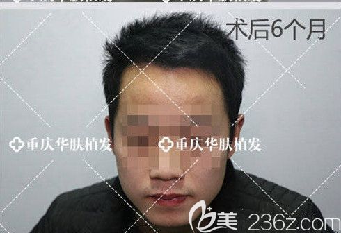 想看頭頂稀疏脫發(fā)患者，植發(fā)后1-6個月的效果圖嗎?那就速來圍觀