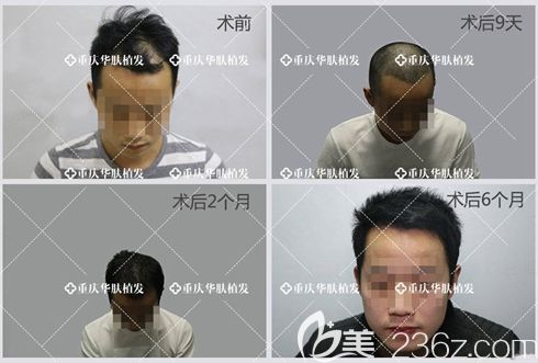 植發(fā)1-6個月的正常效果圖