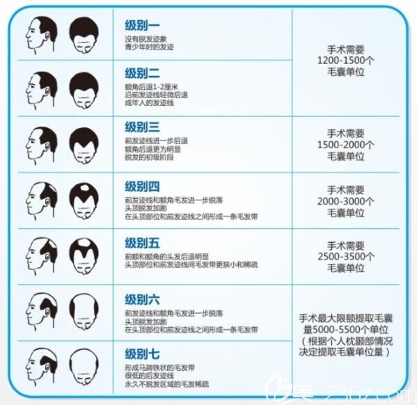 男士脫發(fā)等級示意圖