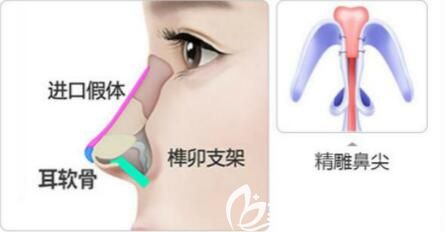 埃菲爾隆鼻技術(shù)優(yōu)勢(shì)