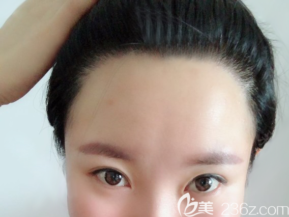 ?額頭兩邊發(fā)際線高讓我的臉大了1倍!這個(gè)問題在發(fā)際線種植1800毛囊單位后終于解決了