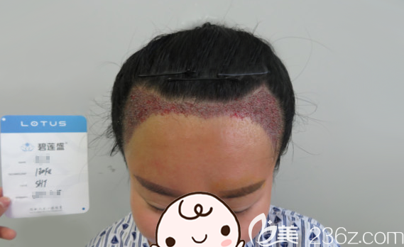 剛做完發(fā)際線種植，額頭看著小多了